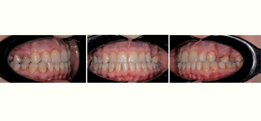 CAZ 10 AFTER