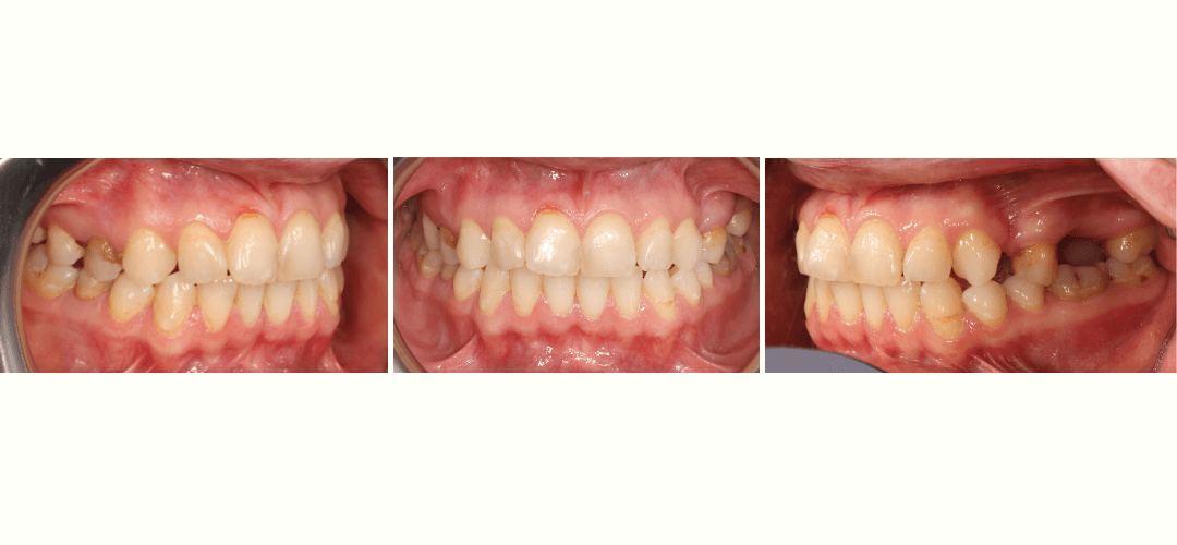 CAZ 10 BEFORE