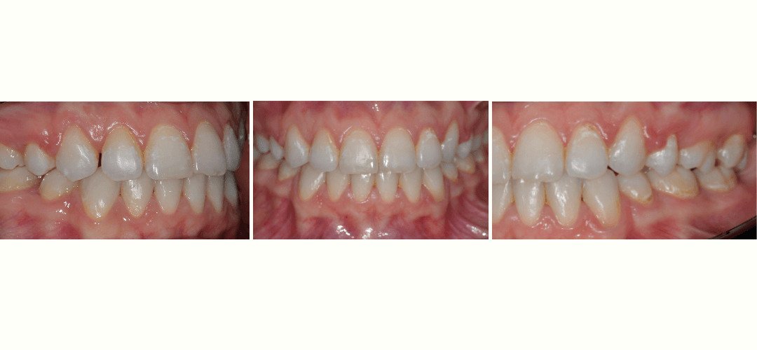 CAZ 12 BEFORE