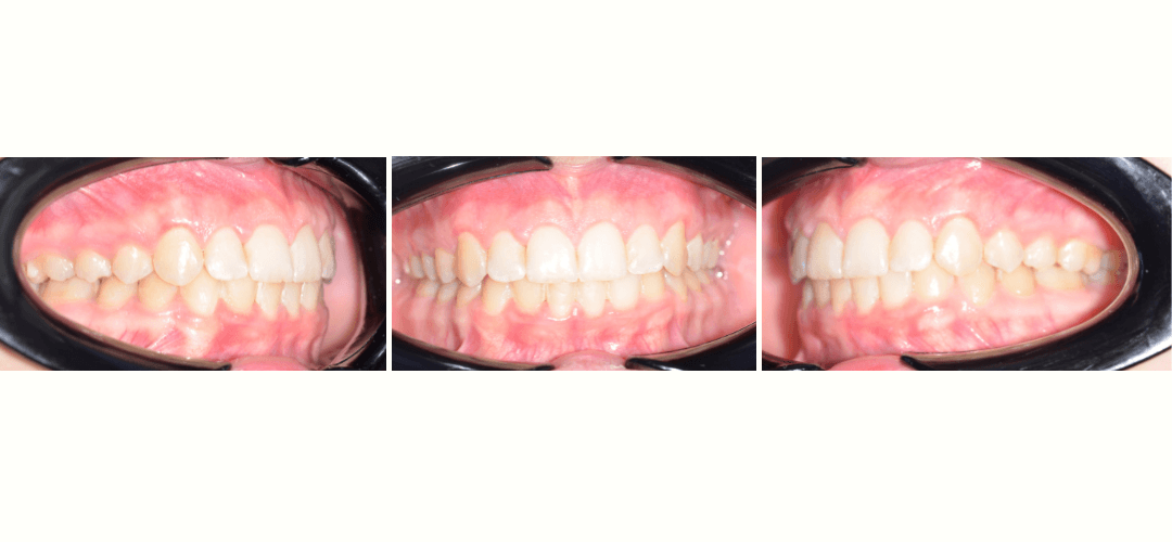 CAZ 14 AFTER