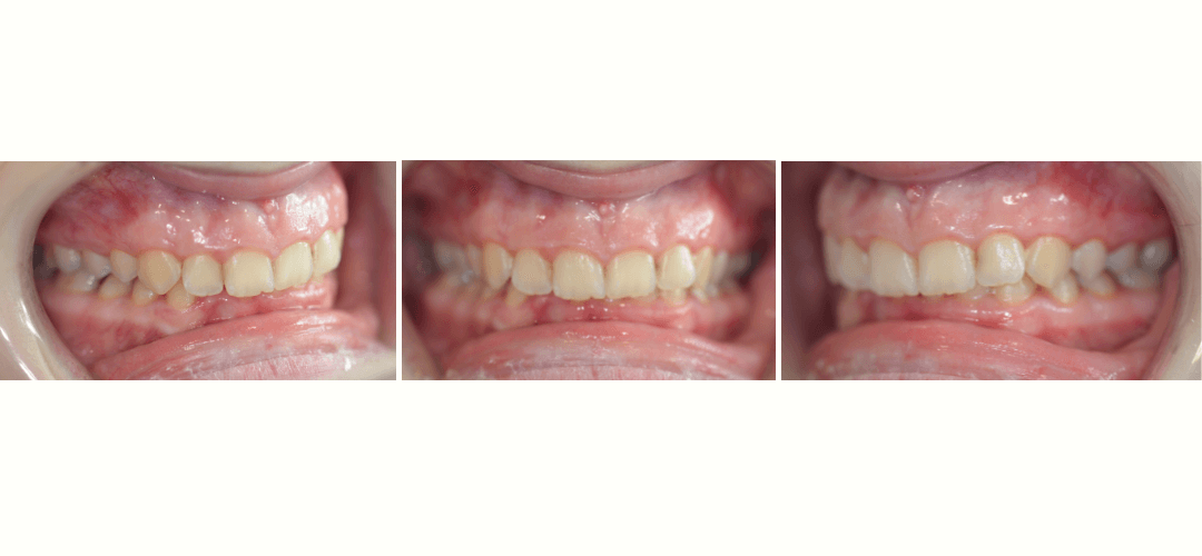 CAZ 14 BEFORE