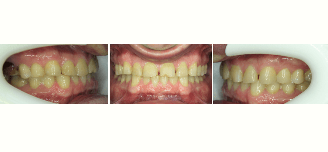 CAZ 19 BEFORE