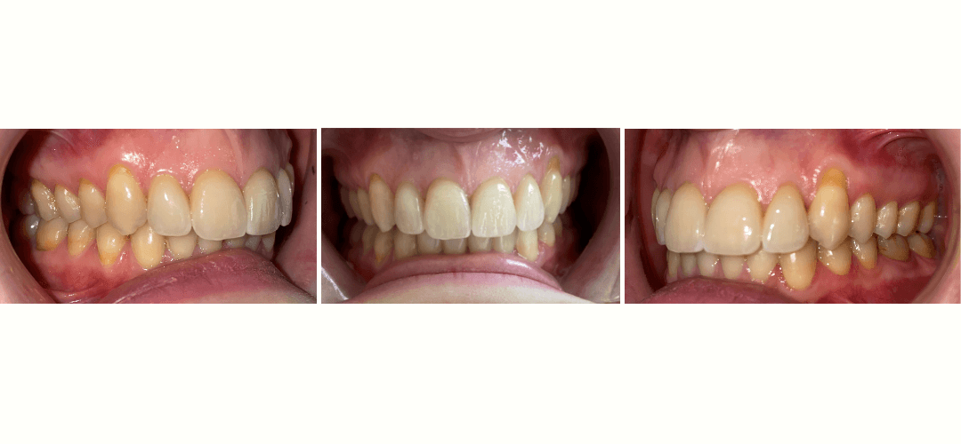 CAZ 2 AFTER