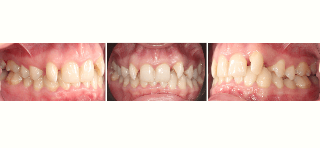 CAZ 20 BEFORE