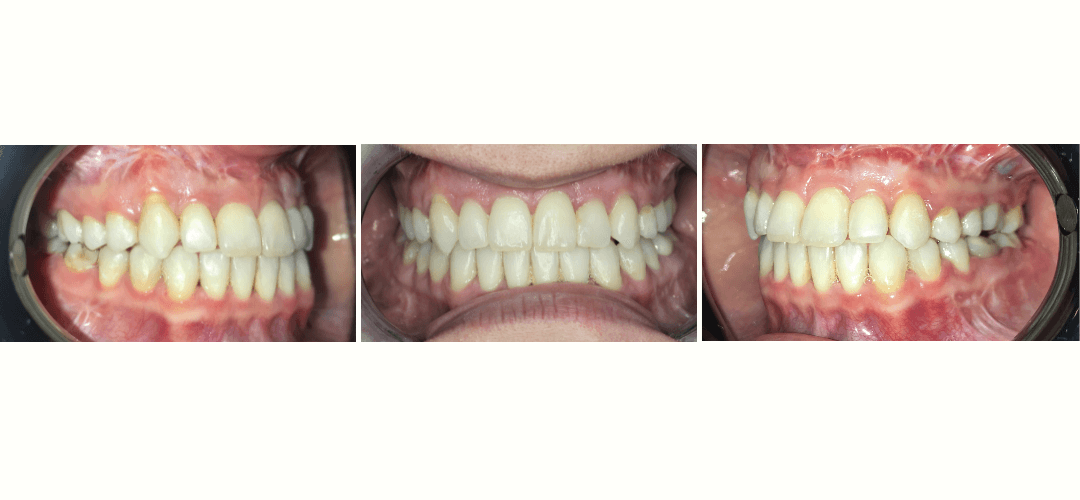 CAZ 26 AFTER