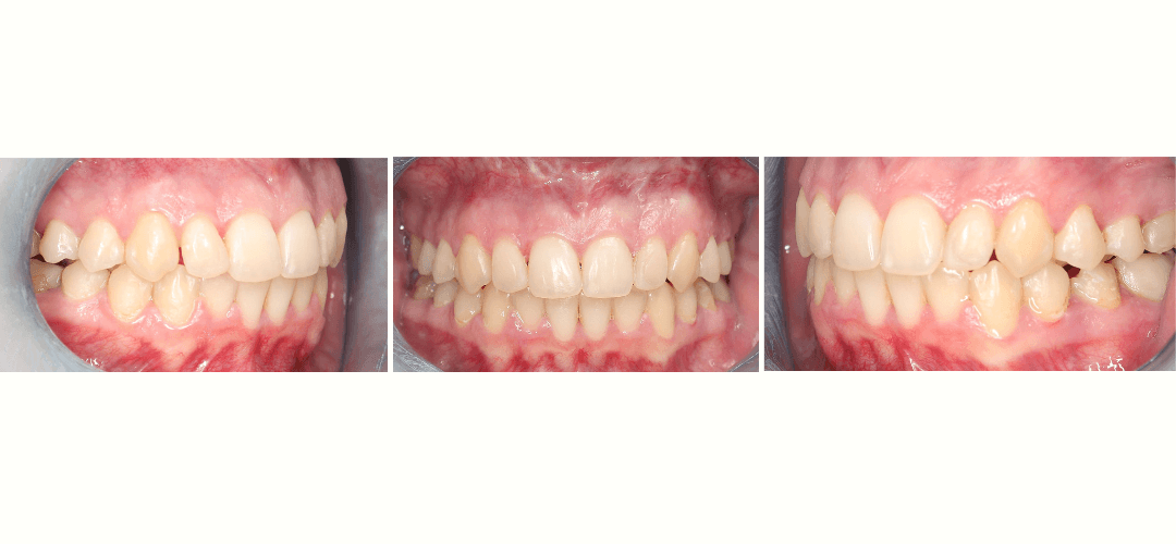 CAZ 27 AFTER
