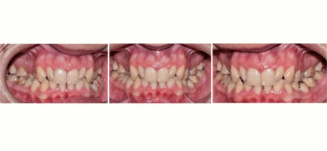 CAZ 27 BEFORE
