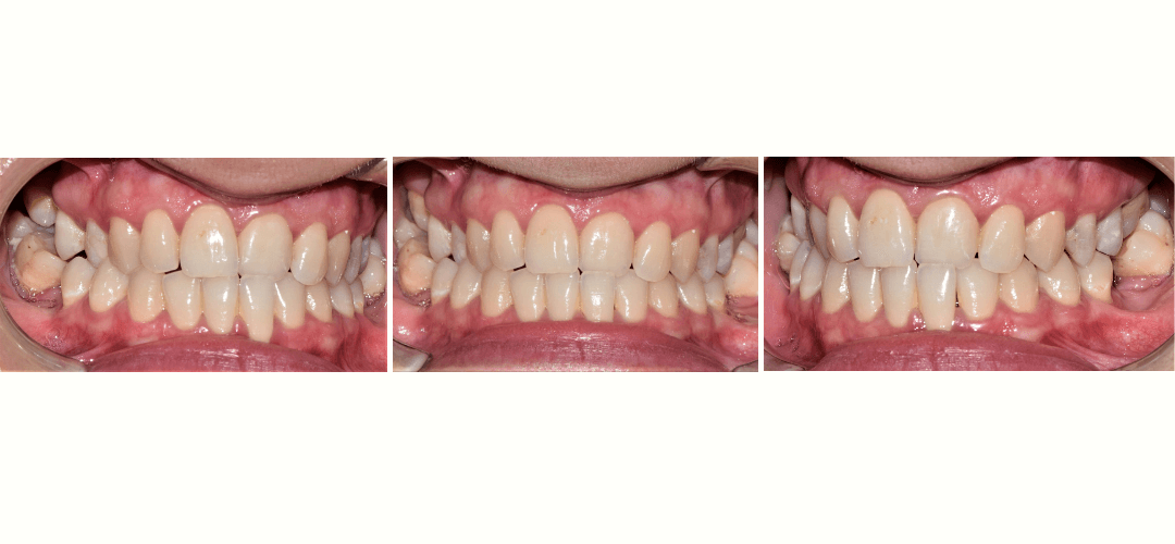 CAZ 32 BEFORE
