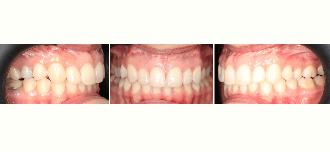 CAZ 34 AFTER