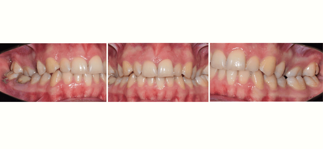 CAZ 34 BEFORE