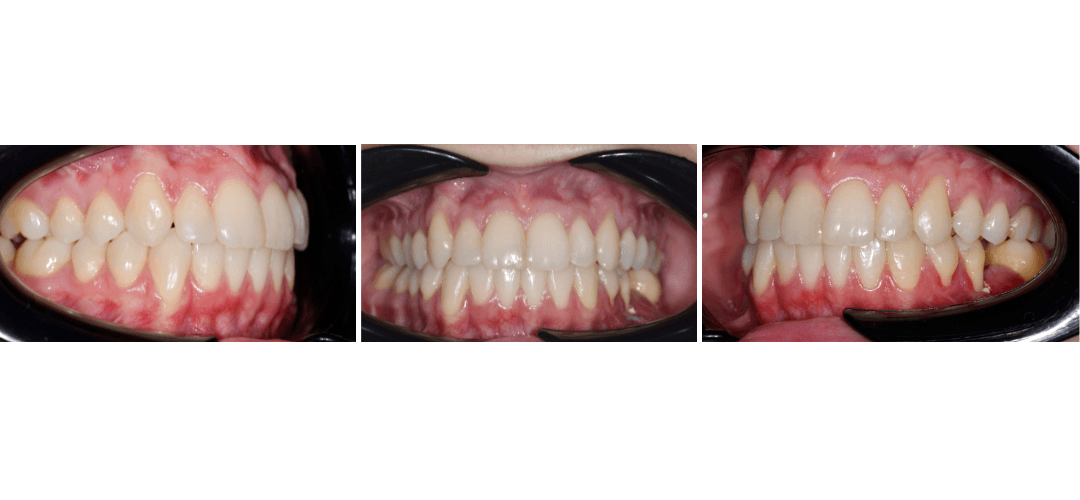 CAZ 9 AFTER