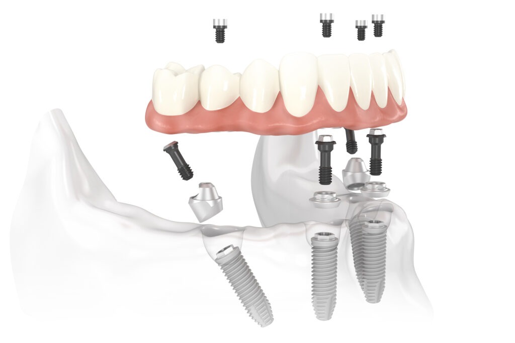 Ilustrație a unei lucrări fixe complete susținute de patru implanturi dentare