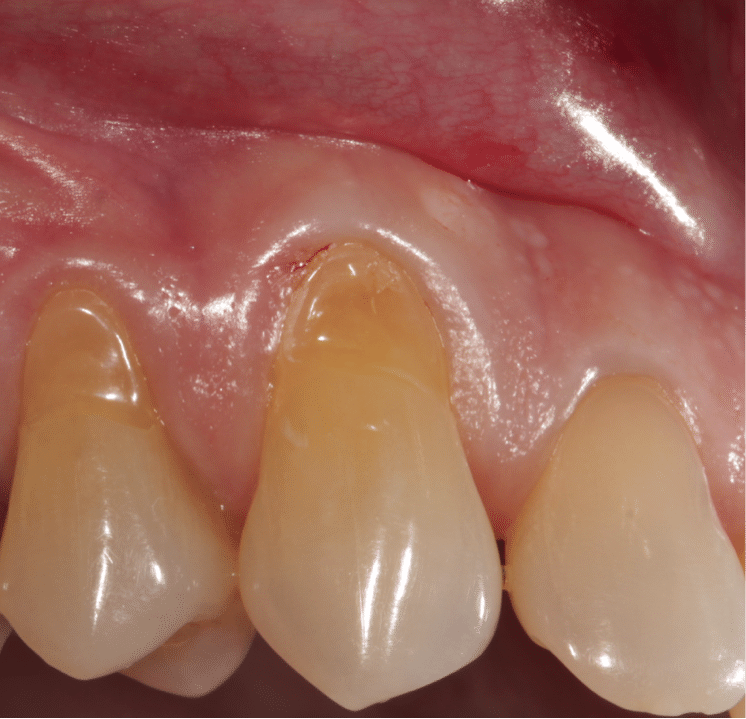 Exemplu educațional de retracție gingivală și rădăcini dentare expuse
