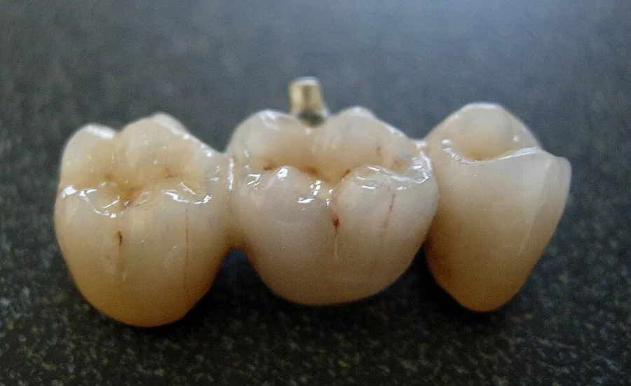 Punte dentară ceramică de trei elemente, exemplu de lucrare protetică